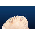 Anatomical Implant Restoration Crown